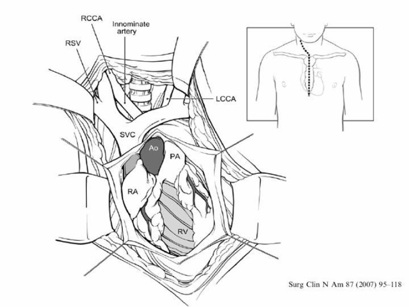 Diapositiva 20 de Hemotórax Masivo