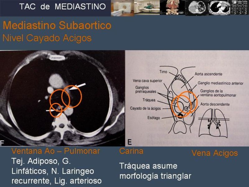 Diapositiva 16 de Imaginología Toráxica TAC