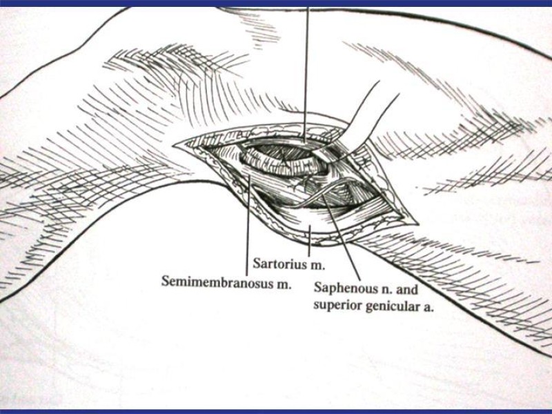 Diapositiva 96 de Abordaje Quirúrgico Vasculares