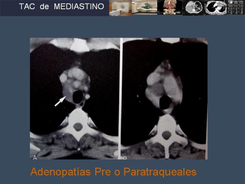 Diapositiva 34 de Imaginología Toráxica TAC