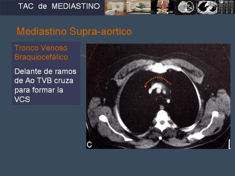 Diapositiva 8 de Imaginología Toráxica TAC