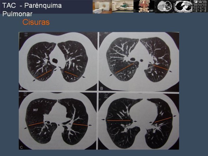 Diapositiva 57 de Imaginología Toráxica TAC