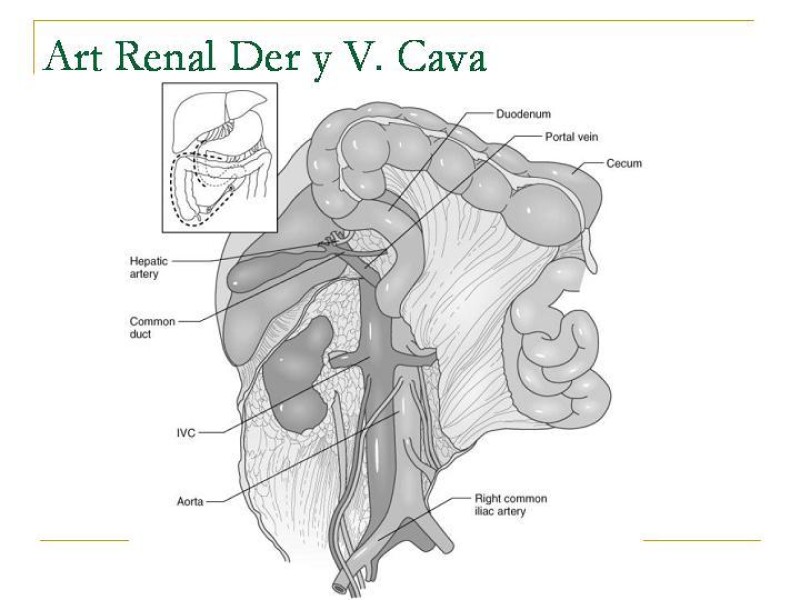Diapositiva 35 de Accesos vasculares Abdominales