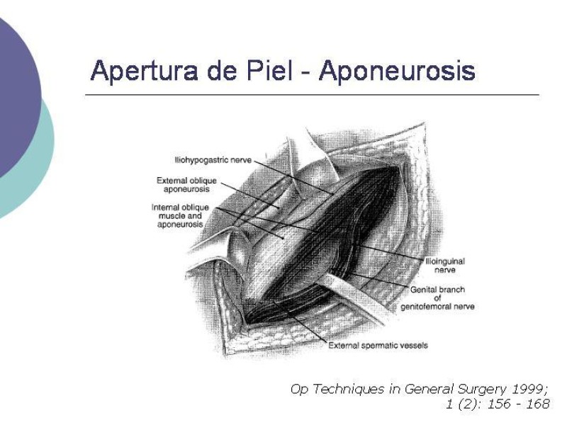 Diapositiva 7 de Hernia Inguinal: Técnica de Lichtenstein