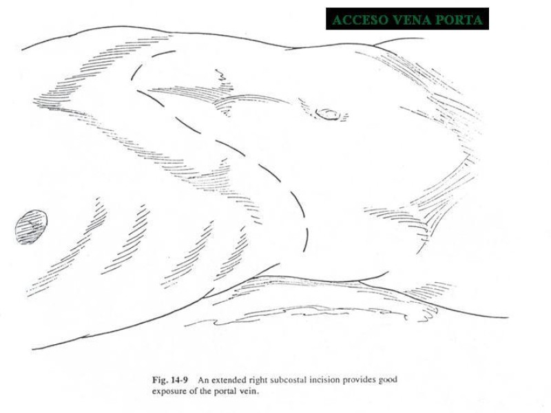 Diapositiva 95 de Accesos vasculares Abdominales