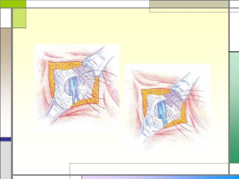 Diapositiva 16 de Tratamiento de la Hernia Femoral