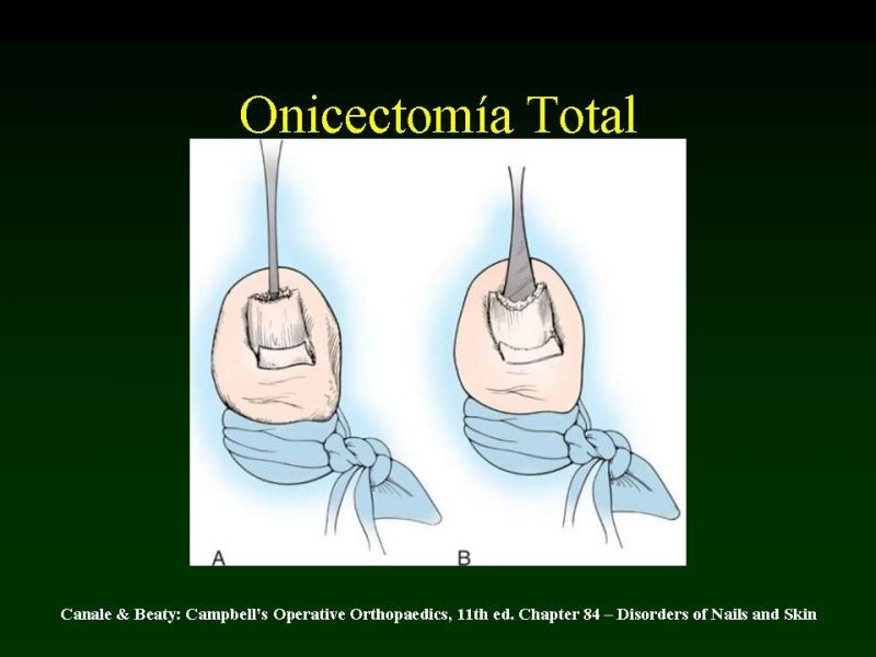 Diapositiva 8 de Técnica de la Onicectomía