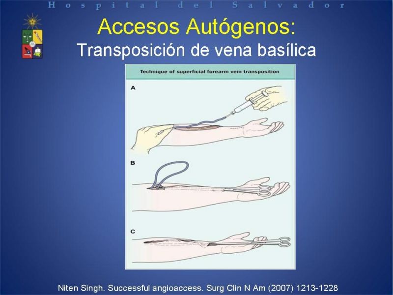 Diapositiva 20 de Reunión de Técnica Quirúrgica: Accesos Vasculares para Hemodiálisis