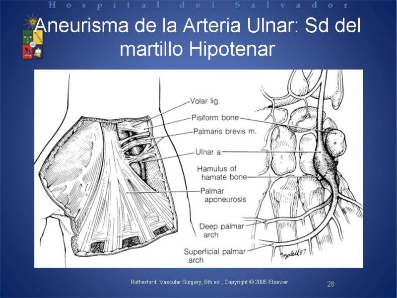 Diapositiva 27 de Aneurismas periféricos