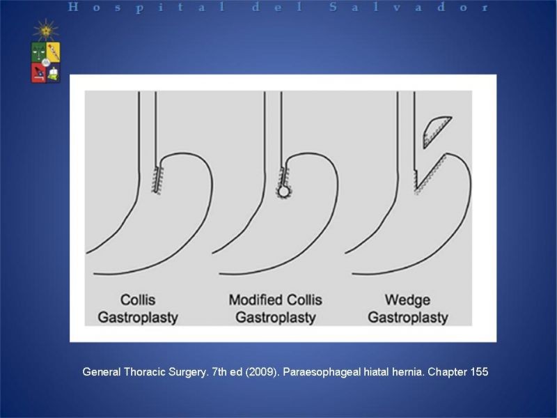 Diapositiva 29 de Hernia Hiatal