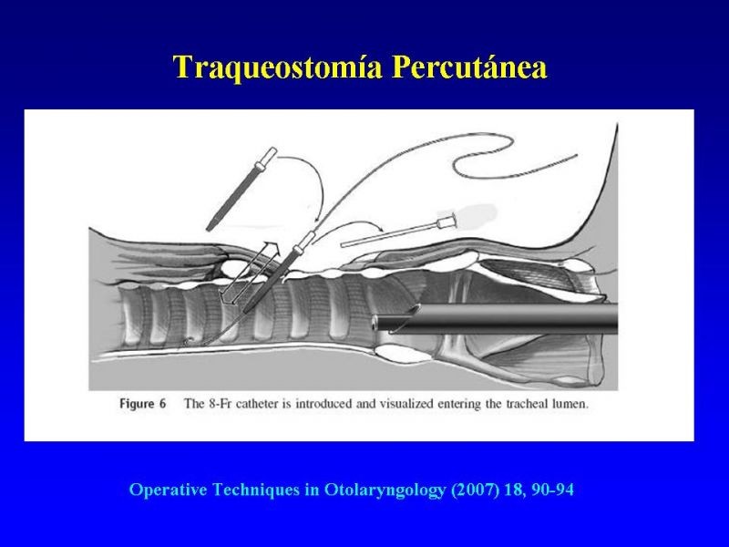 Diapositiva 26 de Traqueostomía