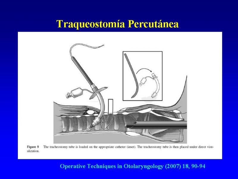 Diapositiva 29 de Traqueostomía