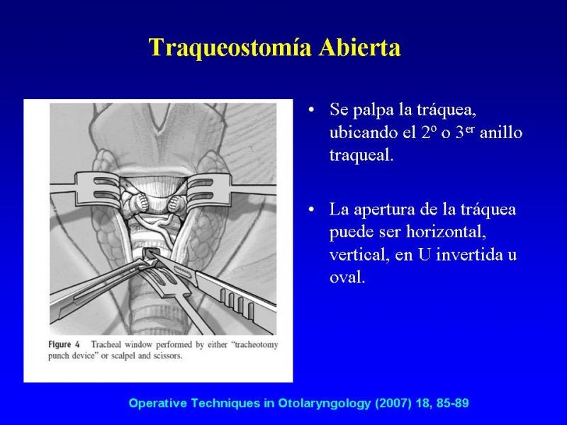 Diapositiva 14 de Traqueostomía
