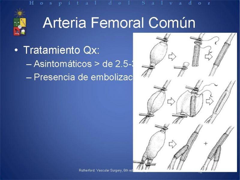 Diapositiva 11 de Aneurismas periféricos