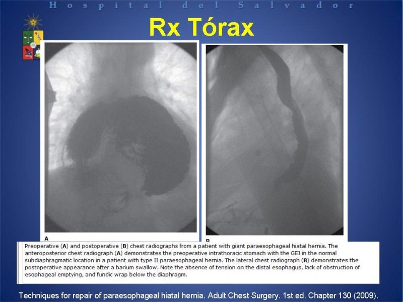 Diapositiva 16 de Hernia Hiatal