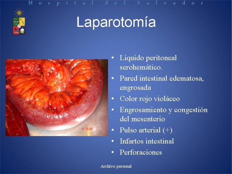 Diapositiva 15 de Trombosis Venosa Mesentérica