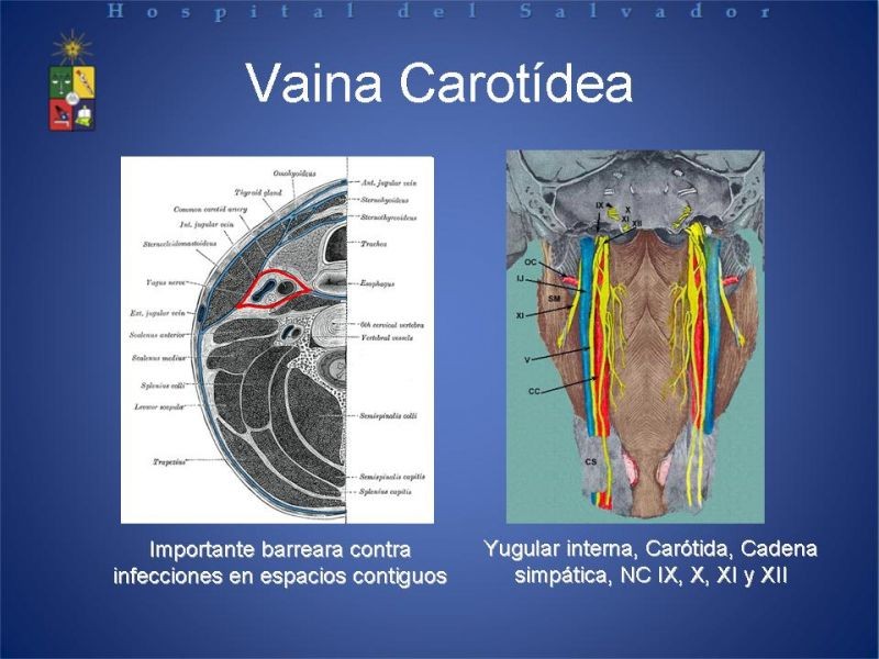 Diapositiva 8 de Abscesos Cervicales Profundos