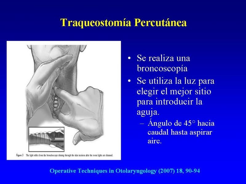 Diapositiva 23 de Traqueostomía
