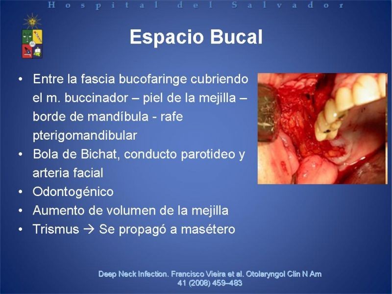 Diapositiva 19 de Abscesos Cervicales Profundos