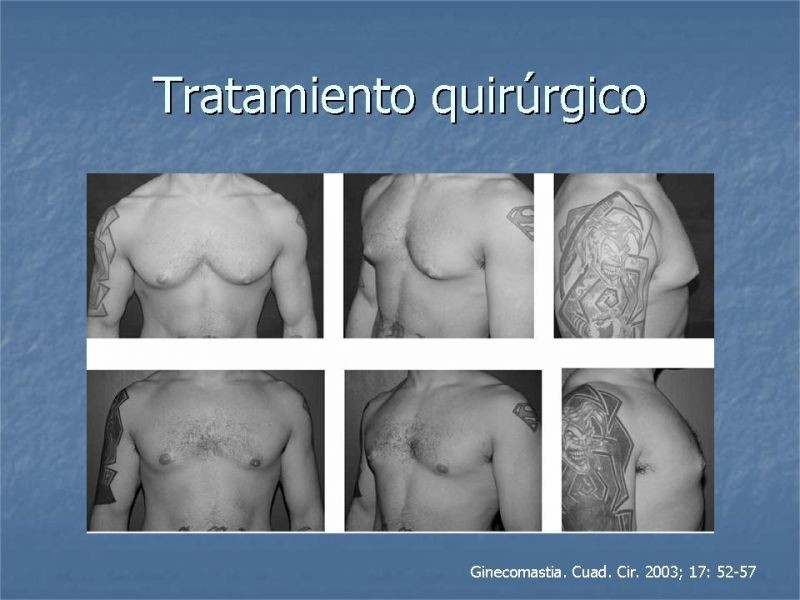 Diapositiva 28 de Ginecomastia