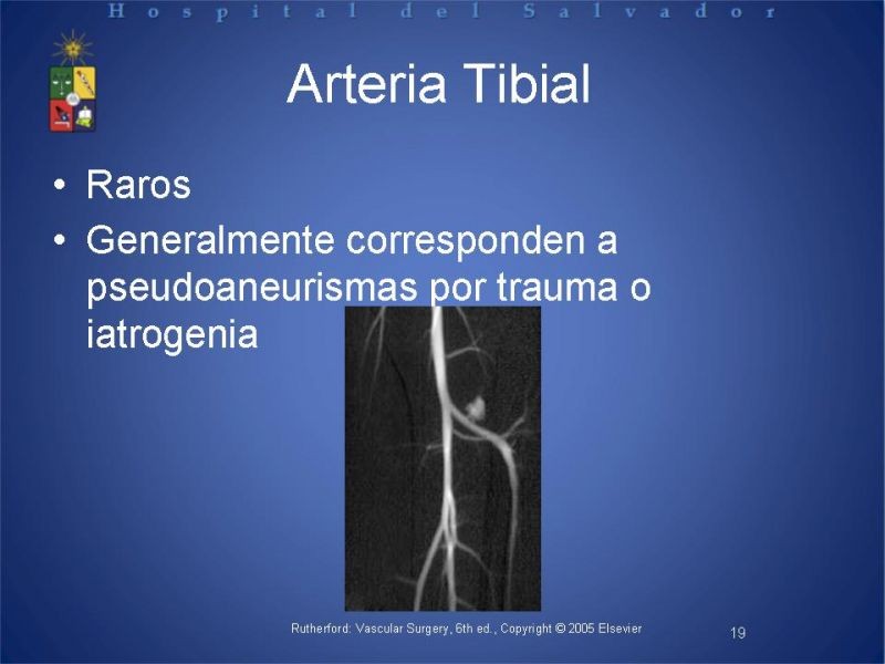 Diapositiva 18 de Aneurismas periféricos