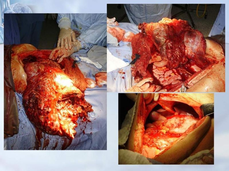 Diapositiva 32 de Sarcomas Retroperitoneales