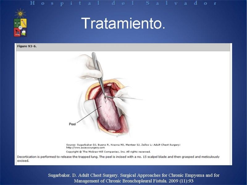 Diapositiva 19 de Empiema Pleural: Paraneumónico, posquirúrgico y post resección pulmonar. Tratamiento quirúrgico.