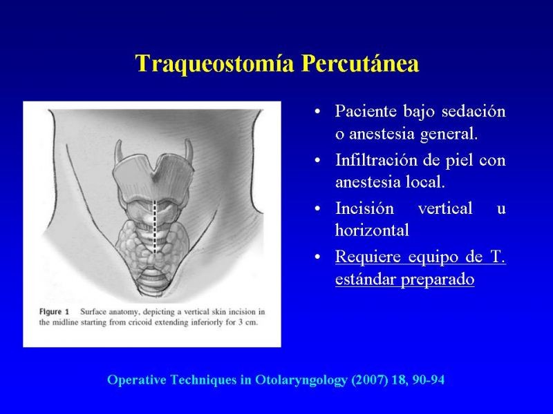 Diapositiva 21 de Traqueostomía