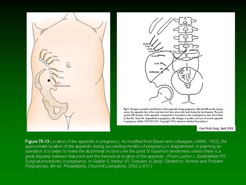 Diapositiva 7 de Apendicitis Aguda y Embarazo