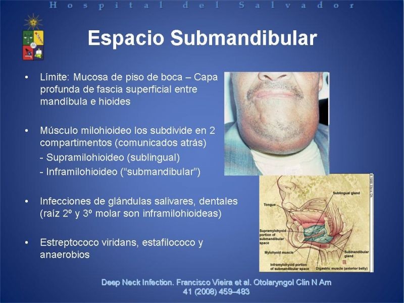 Diapositiva 13 de Abscesos Cervicales Profundos