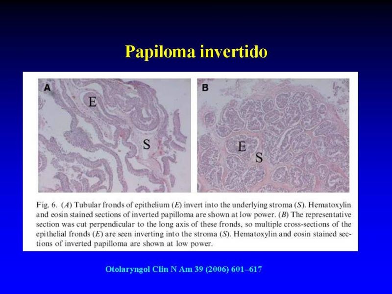Diapositiva 13 de Tumores de Senos Paranasales