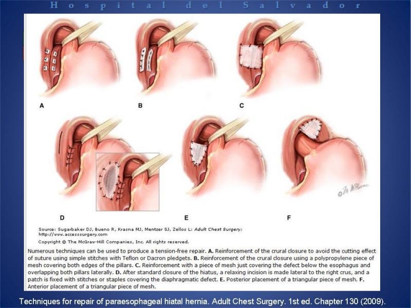 Diapositiva 32 de Hernia Hiatal