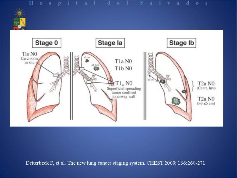 Diapositiva 20 de Cáncer Pulmonar
