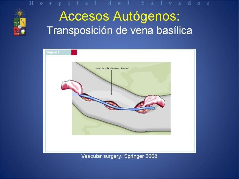 Diapositiva 21 de Reunión de Técnica Quirúrgica: Accesos Vasculares para Hemodiálisis
