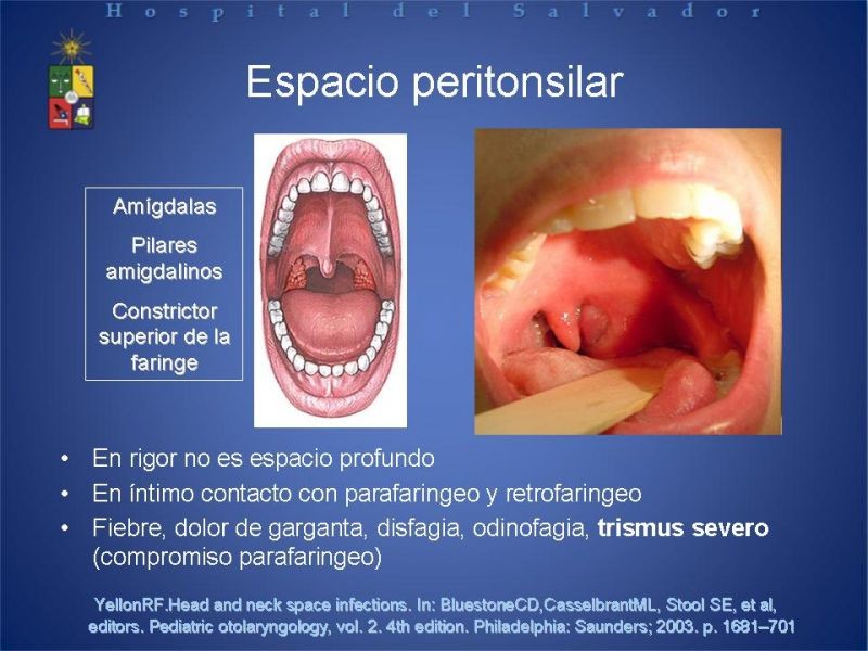 Diapositiva 11 de Abscesos Cervicales Profundos