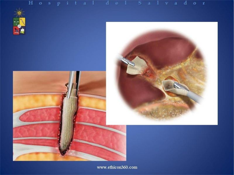 Diapositiva 13 de Hemostasia Hepática: "Surgicel®".