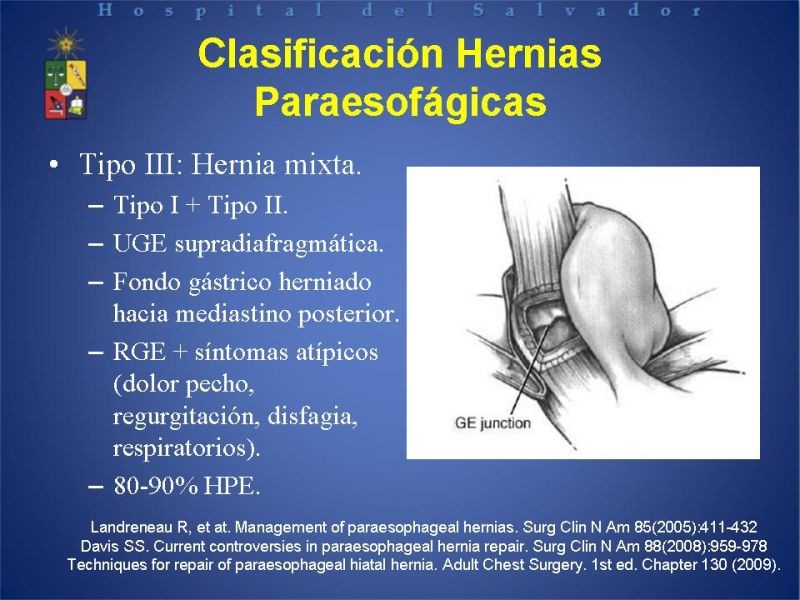 Diapositiva 11 de Hernia Hiatal