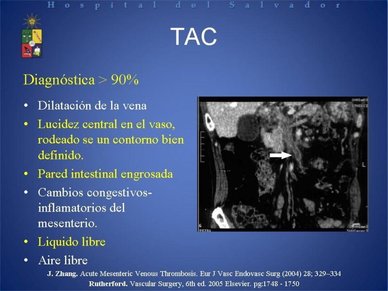 Diapositiva 11 de Trombosis Venosa Mesentérica