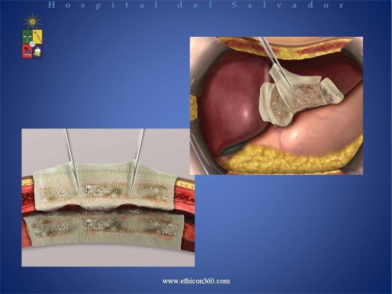 Diapositiva 12 de Hemostasia Hepática: "Surgicel®".