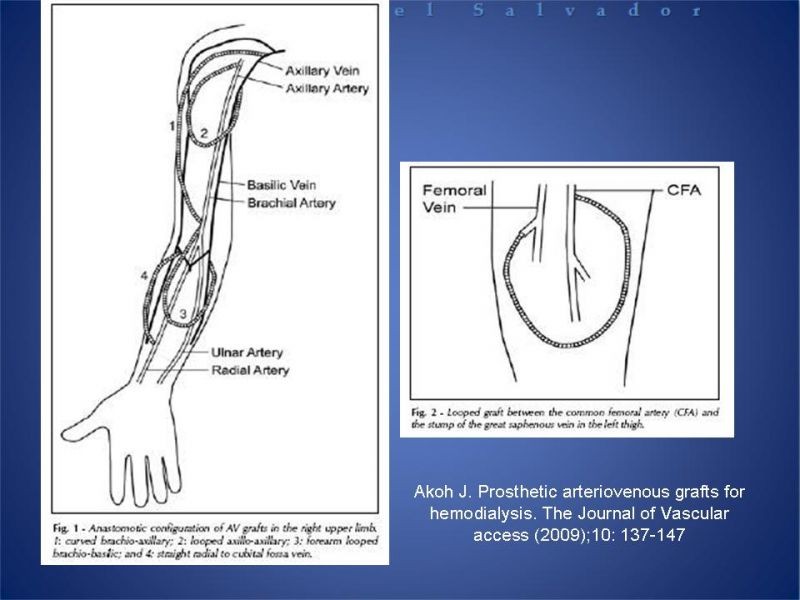 Diapositiva 27 de Reunión de Técnica Quirúrgica: Accesos Vasculares para Hemodiálisis