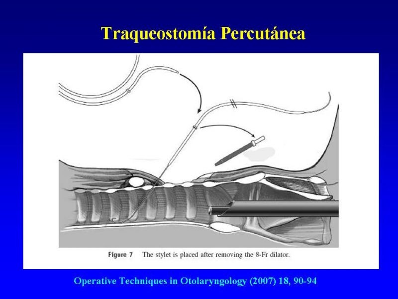 Diapositiva 27 de Traqueostomía