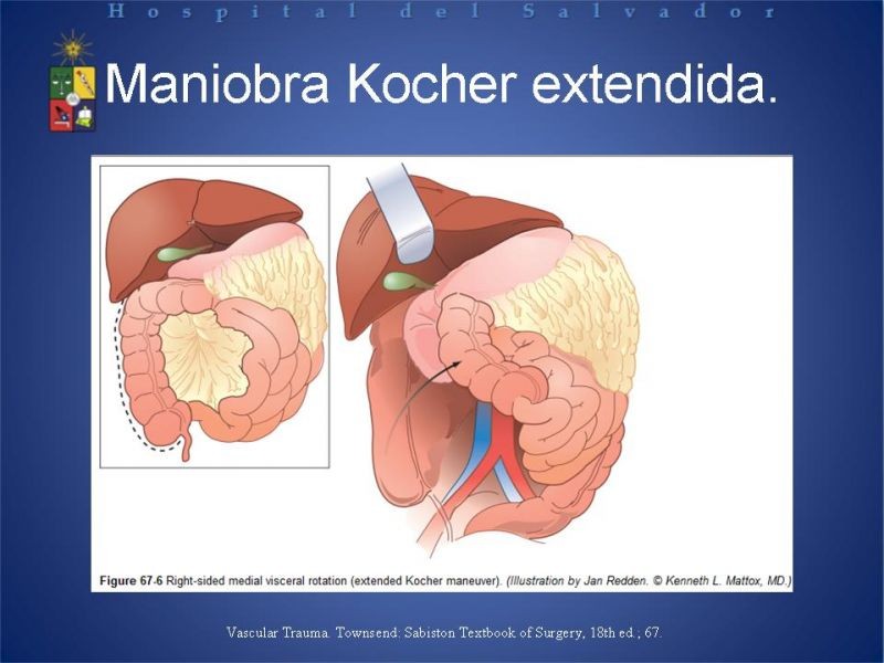 Diapositiva 19 de Trauma Abdominal: Damage Control.