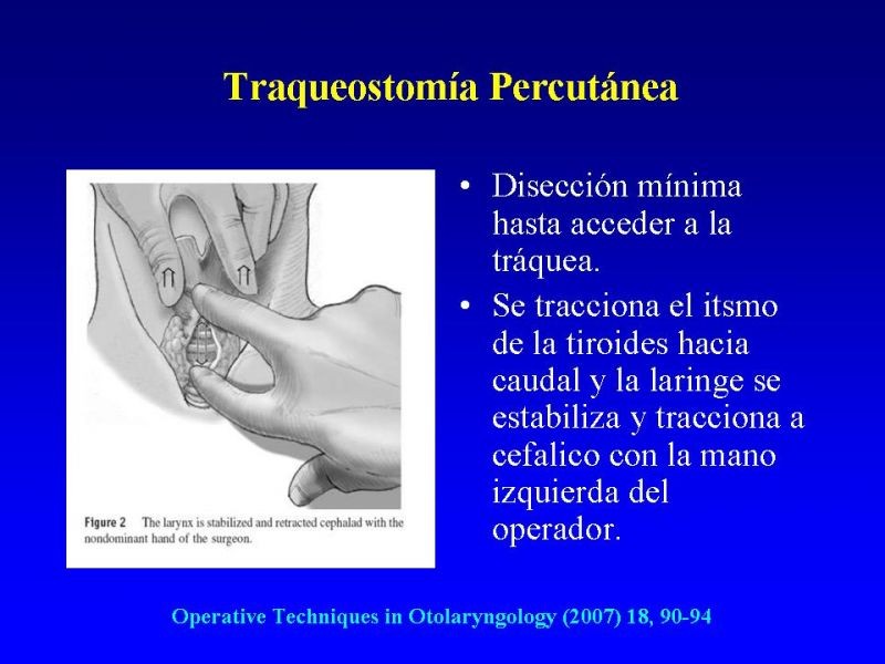 Diapositiva 22 de Traqueostomía