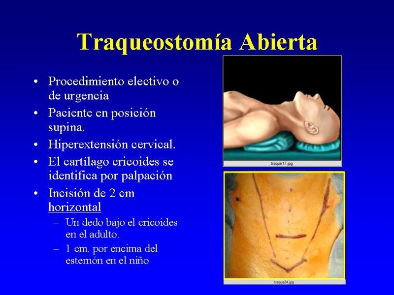 Diapositiva 12 de Traqueostomía
