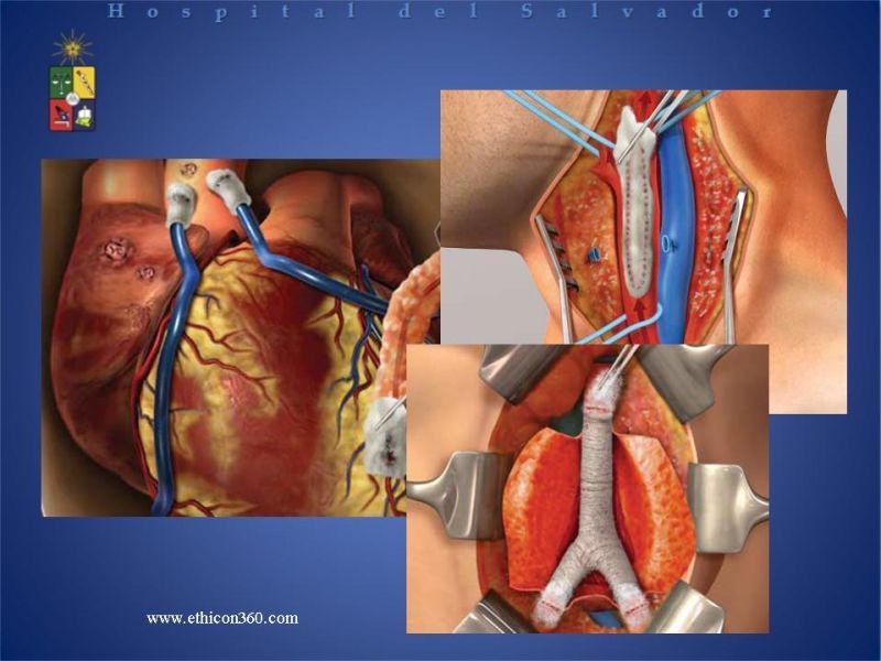 Diapositiva 9 de Hemostasia Hepática: "Surgicel®".