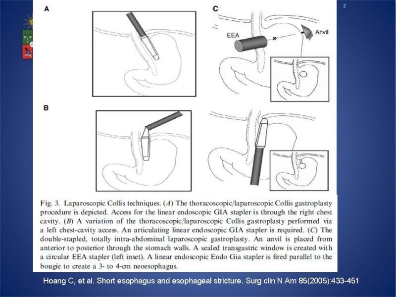 Diapositiva 30 de Hernia Hiatal