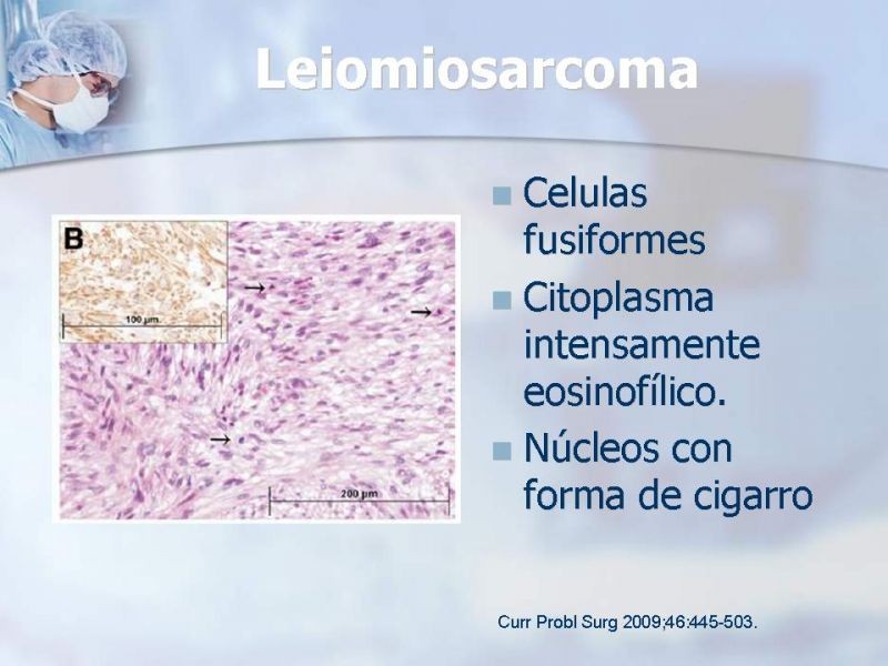 Diapositiva 15 de Sarcomas Retroperitoneales