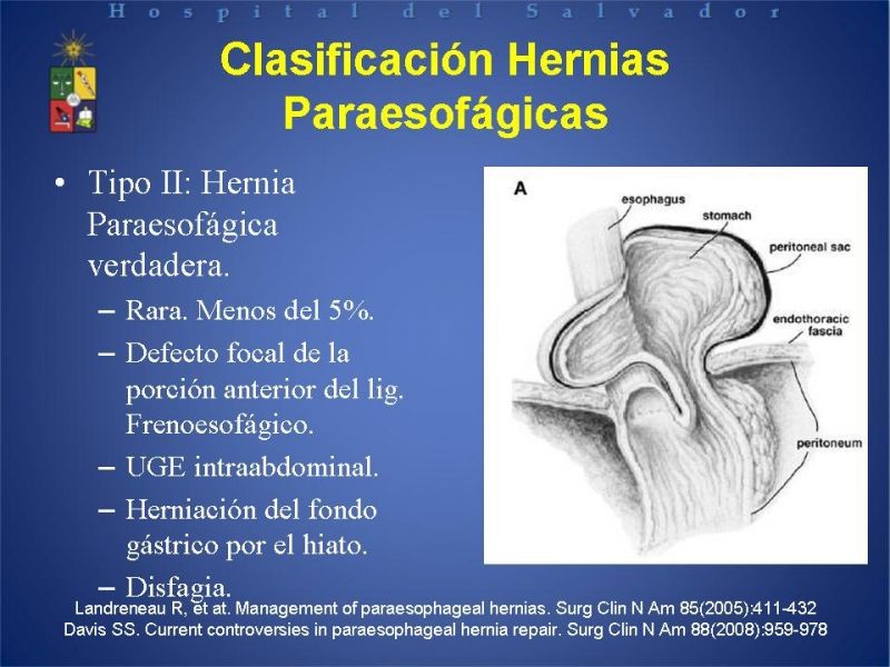 Diapositiva 10 de Hernia Hiatal