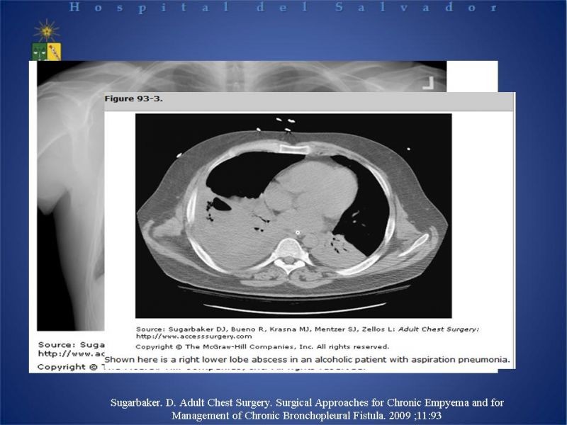 Diapositiva 9 de Empiema Pleural: Paraneumónico, posquirúrgico y post resección pulmonar. Tratamiento quirúrgico.