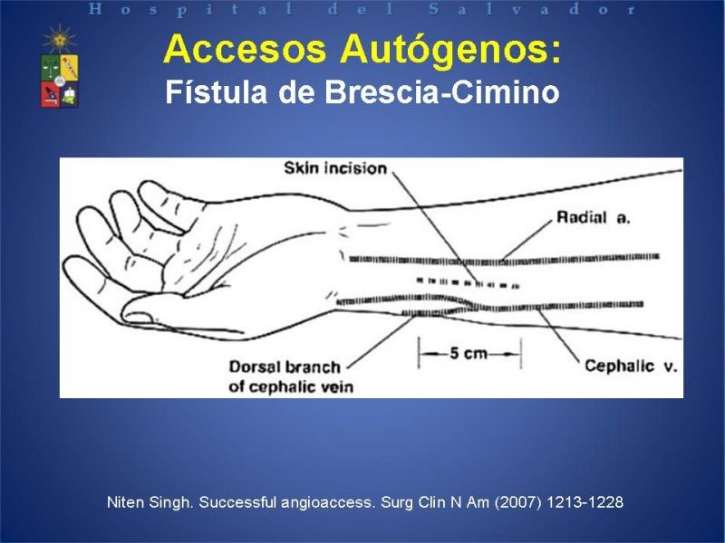 Diapositiva 13 de Reunión de Técnica Quirúrgica: Accesos Vasculares para Hemodiálisis